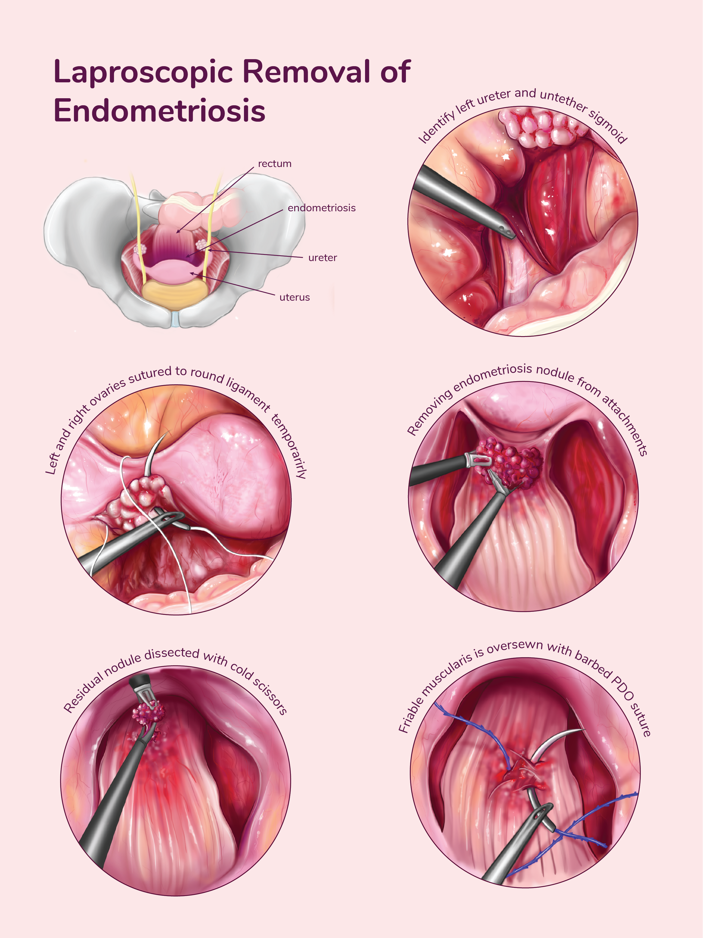 Laproscopic Removal of Endometriosis